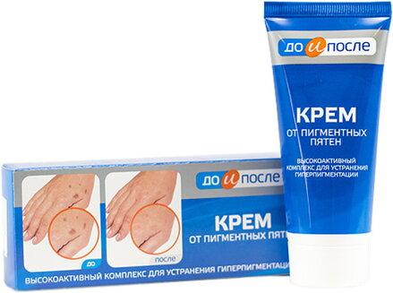 Pred a po: Krém na starecké škvrny 50ml